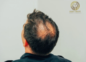 علاج تساقط الشعر